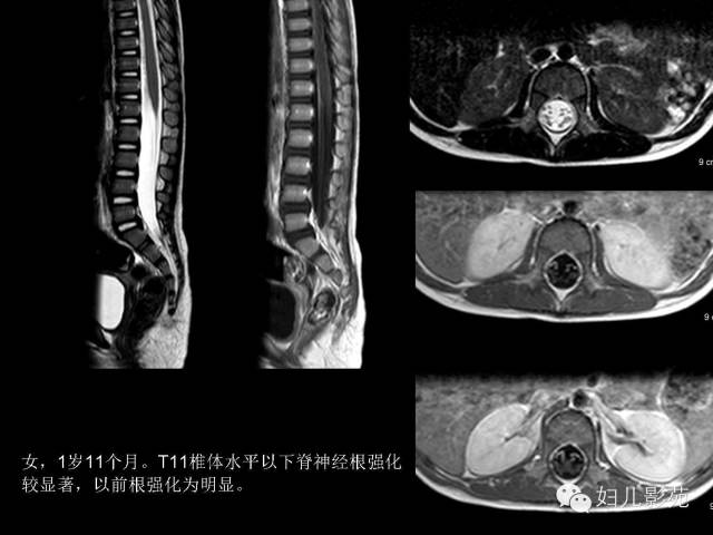 影像PPT - 【PPT】手足口病的神经系统影像表现-22