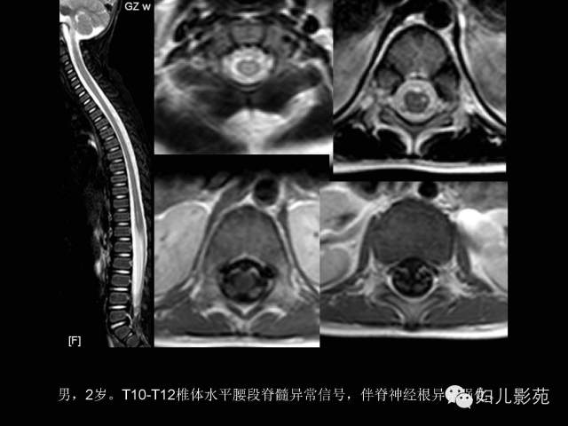 影像PPT - 【PPT】手足口病的神经系统影像表现-23