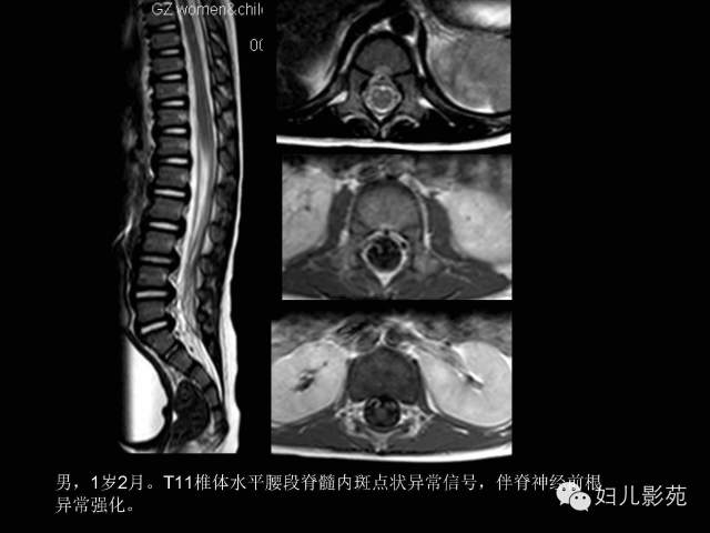 影像PPT - 【PPT】手足口病的神经系统影像表现-25