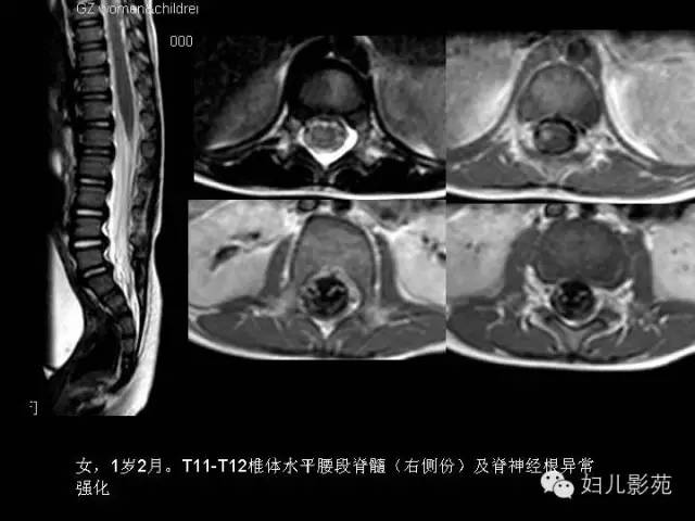 影像PPT - 【PPT】手足口病的神经系统影像表现-24
