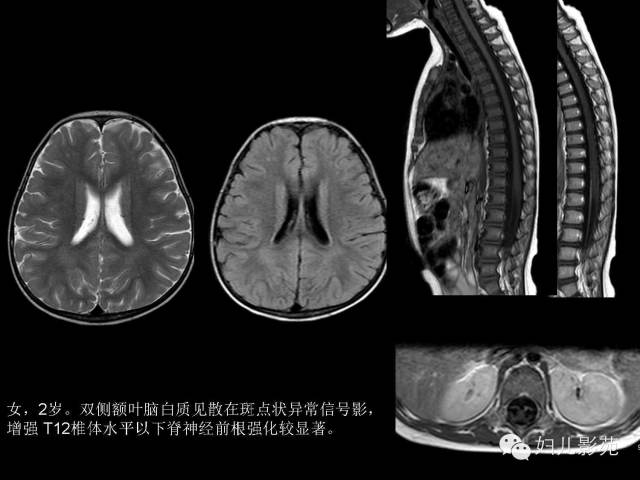影像PPT - 【PPT】手足口病的神经系统影像表现-27