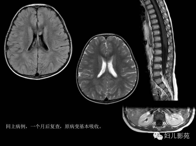影像PPT - 【PPT】手足口病的神经系统影像表现-28