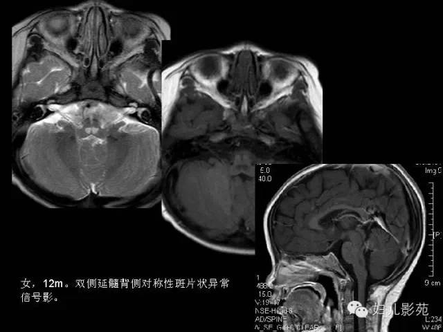影像PPT - 【PPT】手足口病的神经系统影像表现-29