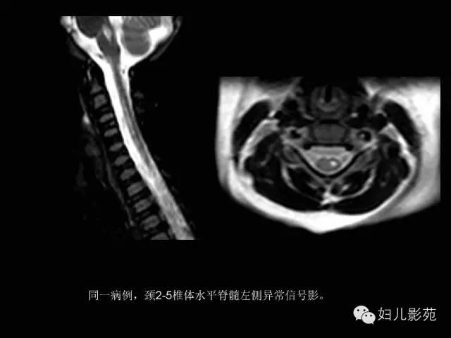 影像PPT - 【PPT】手足口病的神经系统影像表现-30