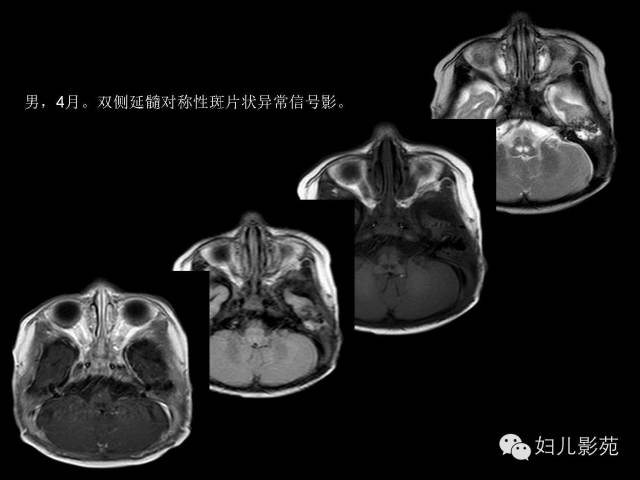 影像PPT - 【PPT】手足口病的神经系统影像表现-33