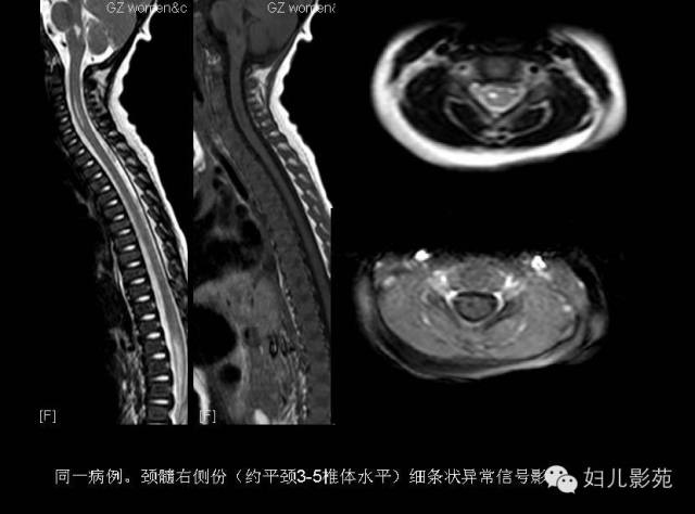 影像PPT - 【PPT】手足口病的神经系统影像表现-34
