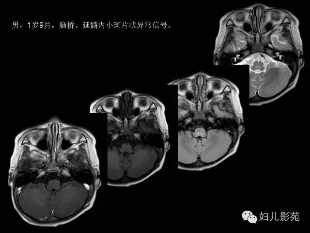 影像PPT - 【PPT】手足口病的神经系统影像表现-35