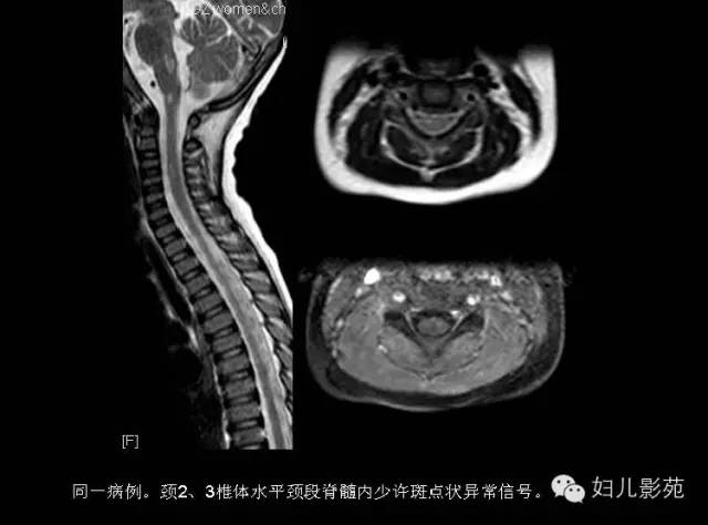 影像PPT - 【PPT】手足口病的神经系统影像表现-36