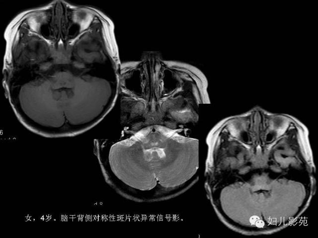 影像PPT - 【PPT】手足口病的神经系统影像表现-37
