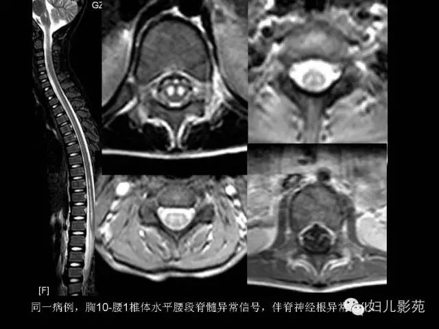 影像PPT - 【PPT】手足口病的神经系统影像表现-38