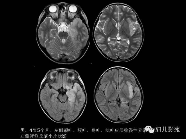 影像PPT - 【PPT】手足口病的神经系统影像表现-40