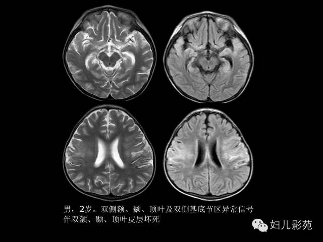 影像PPT - 【PPT】手足口病的神经系统影像表现-41