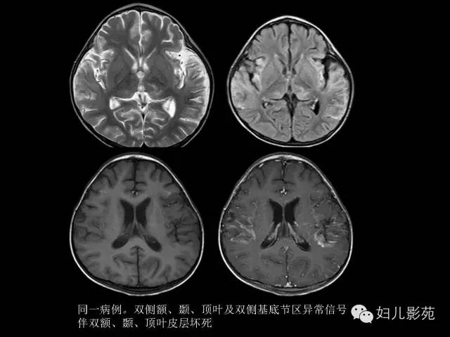 影像PPT - 【PPT】手足口病的神经系统影像表现-42