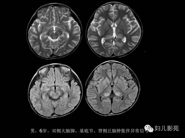 影像PPT - 【PPT】手足口病的神经系统影像表现-44