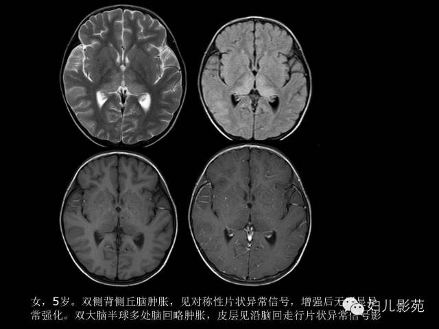 影像PPT - 【PPT】手足口病的神经系统影像表现-45