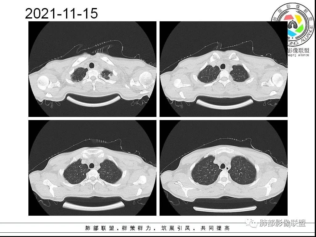 影像PPT - 【病例】HIV背景下的双肺多发性小结节-5 影像PPT - 【病例】HIV背景下的双肺多发性小结节-5