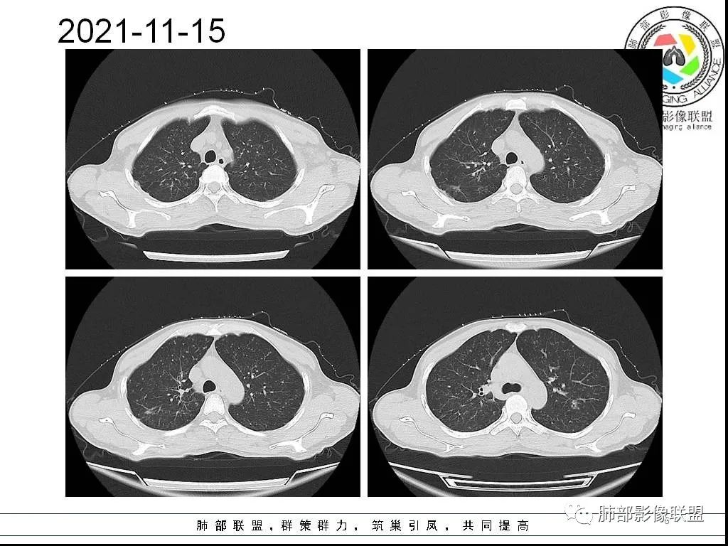 影像PPT - 【病例】HIV背景下的双肺多发性小结节-6 影像PPT - 【病例】HIV背景下的双肺多发性小结节-6