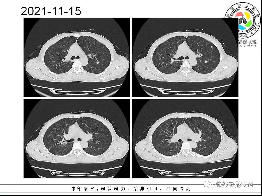 影像PPT - 【病例】HIV背景下的双肺多发性小结节-7 影像PPT - 【病例】HIV背景下的双肺多发性小结节-7