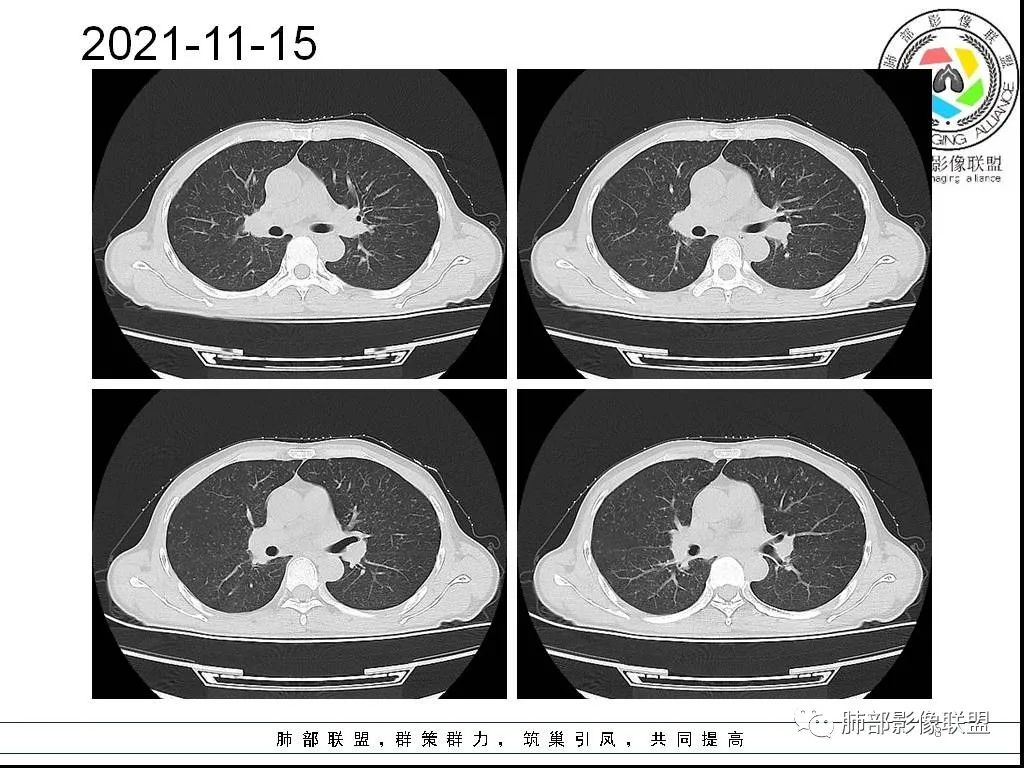 影像PPT - 【病例】HIV背景下的双肺多发性小结节-8 影像PPT - 【病例】HIV背景下的双肺多发性小结节-8