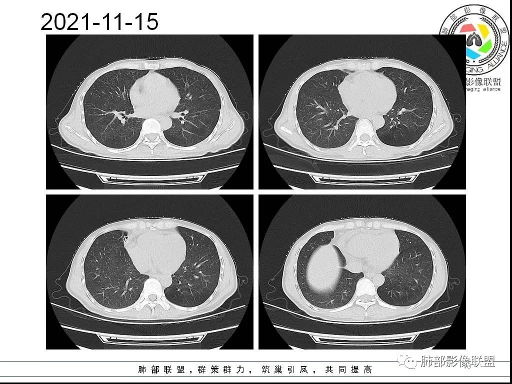 影像PPT - 【病例】HIV背景下的双肺多发性小结节-10 影像PPT - 【病例】HIV背景下的双肺多发性小结节-10