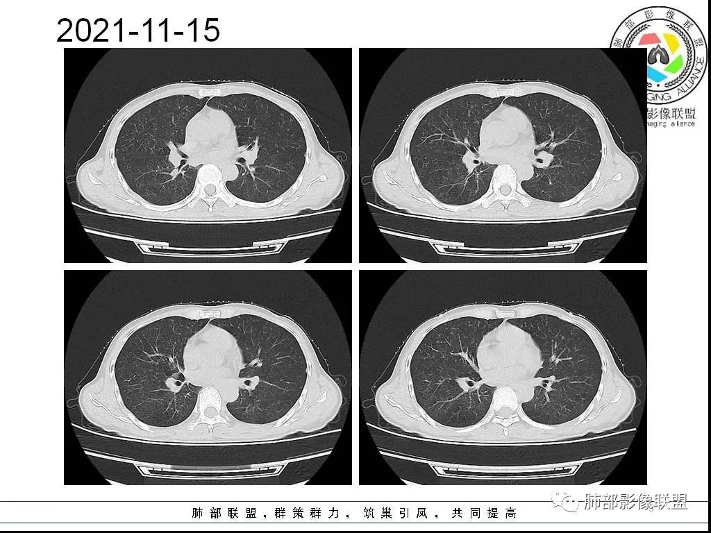 影像PPT - 【病例】HIV背景下的双肺多发性小结节-9 影像PPT - 【病例】HIV背景下的双肺多发性小结节-9