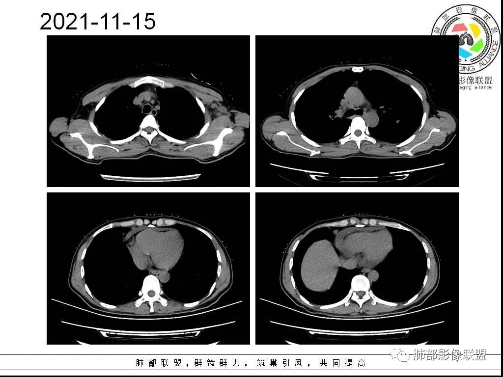 影像PPT - 【病例】HIV背景下的双肺多发性小结节-11 影像PPT - 【病例】HIV背景下的双肺多发性小结节-11