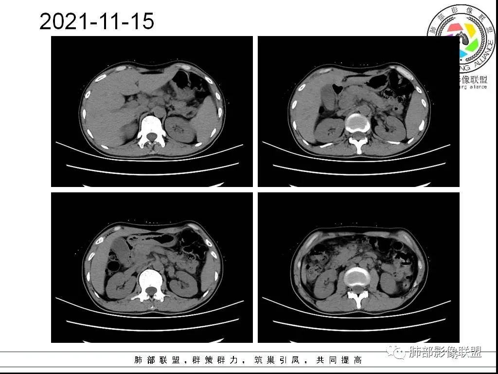 影像PPT - 【病例】HIV背景下的双肺多发性小结节-12 影像PPT - 【病例】HIV背景下的双肺多发性小结节-12