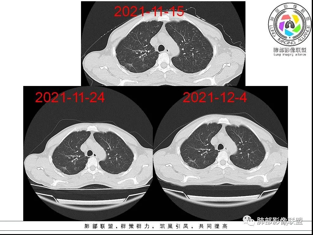 影像PPT - 【病例】HIV背景下的双肺多发性小结节-13 影像PPT - 【病例】HIV背景下的双肺多发性小结节-13
