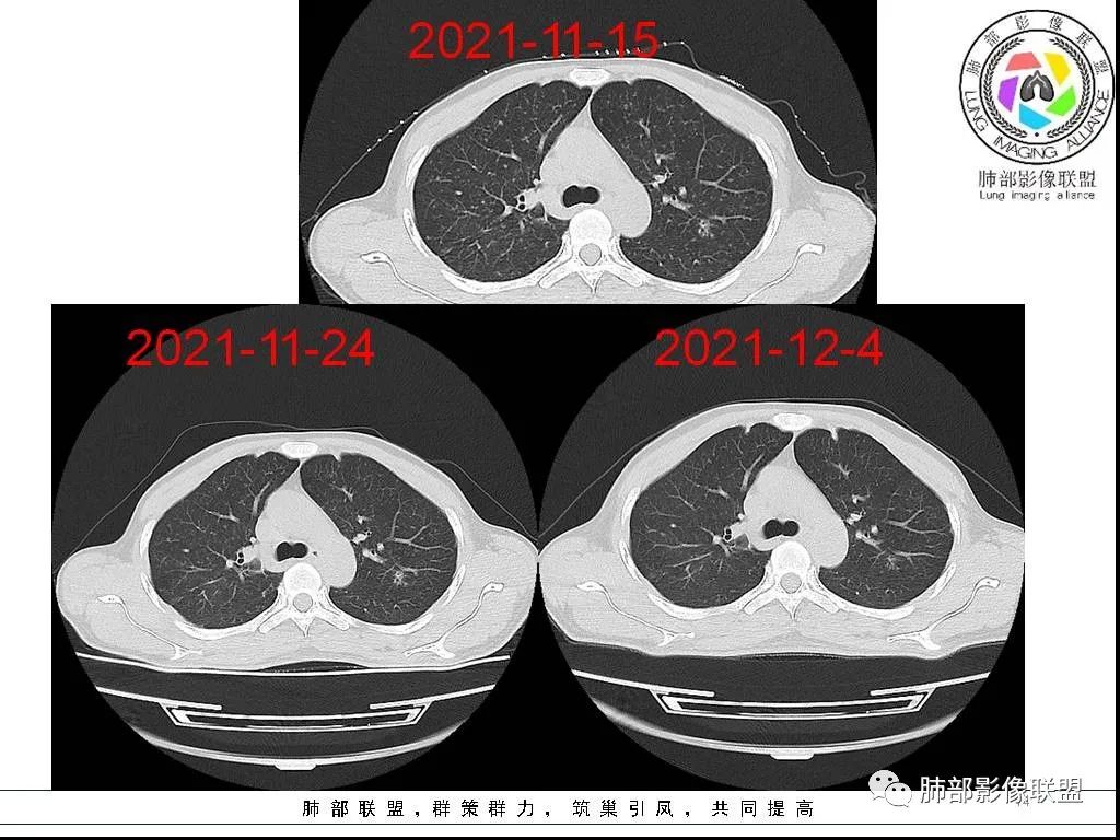 影像PPT - 【病例】HIV背景下的双肺多发性小结节-14 影像PPT - 【病例】HIV背景下的双肺多发性小结节-14