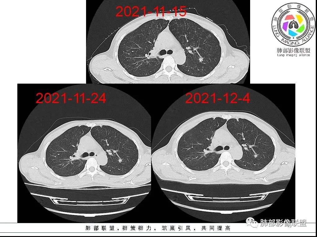 影像PPT - 【病例】HIV背景下的双肺多发性小结节-15 影像PPT - 【病例】HIV背景下的双肺多发性小结节-15