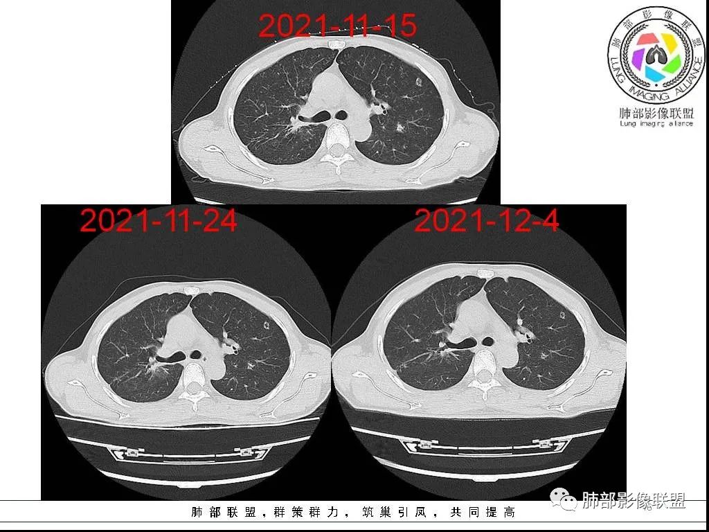 影像PPT - 【病例】HIV背景下的双肺多发性小结节-16 影像PPT - 【病例】HIV背景下的双肺多发性小结节-16