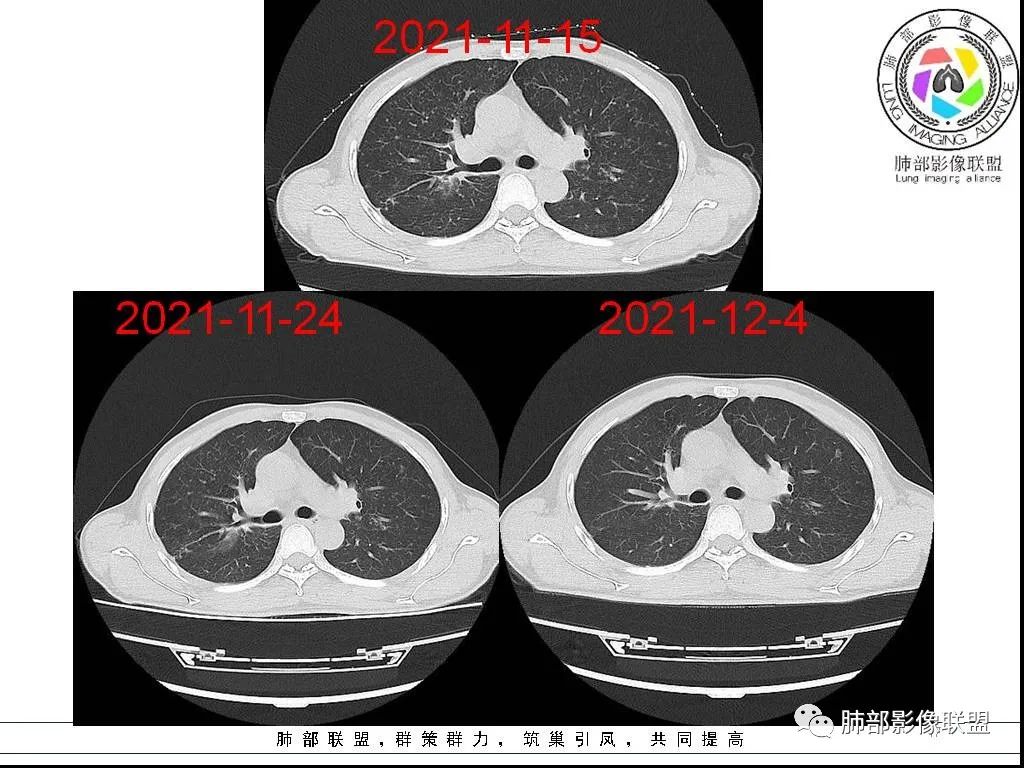 影像PPT - 【病例】HIV背景下的双肺多发性小结节-17 影像PPT - 【病例】HIV背景下的双肺多发性小结节-17