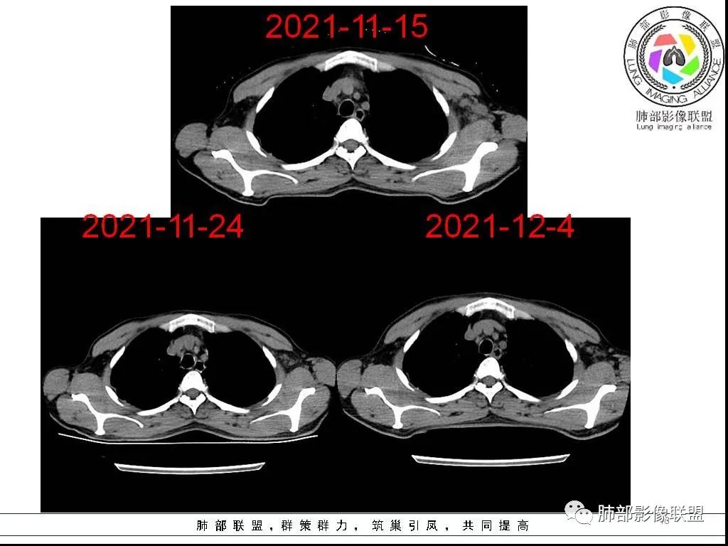 影像PPT - 【病例】HIV背景下的双肺多发性小结节-18 影像PPT - 【病例】HIV背景下的双肺多发性小结节-18