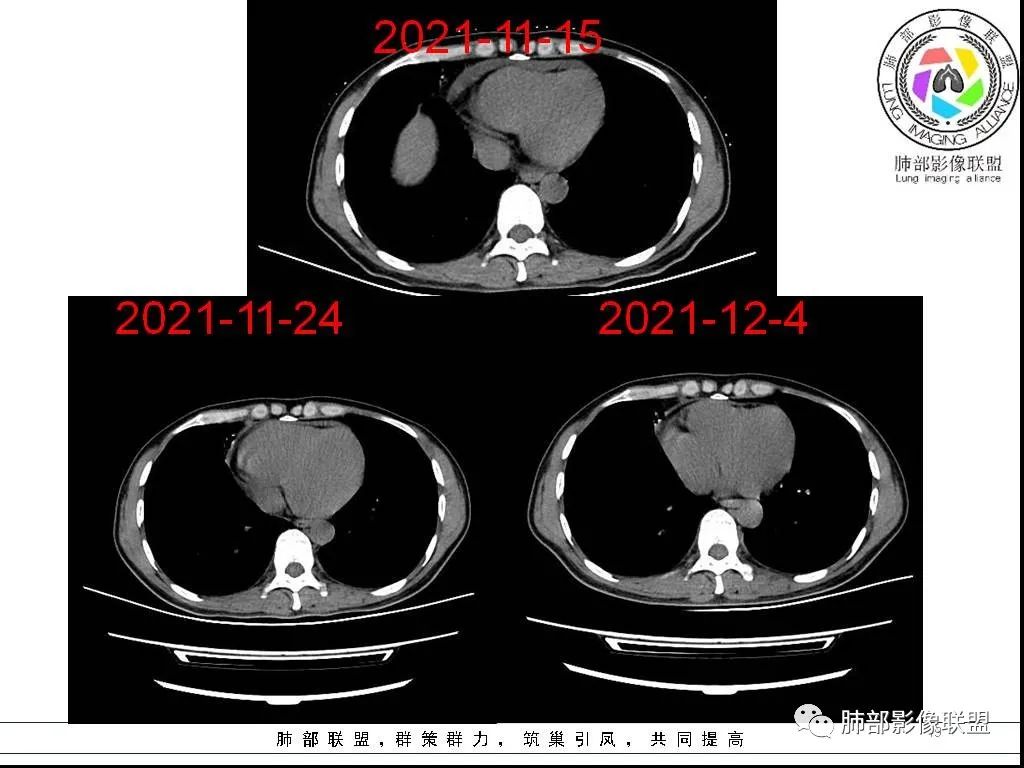 影像PPT - 【病例】HIV背景下的双肺多发性小结节-19 影像PPT - 【病例】HIV背景下的双肺多发性小结节-19