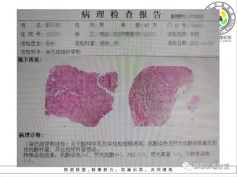 影像PPT - 【病例】HIV背景下的双肺多发性小结节-29 影像PPT - 【病例】HIV背景下的双肺多发性小结节-29