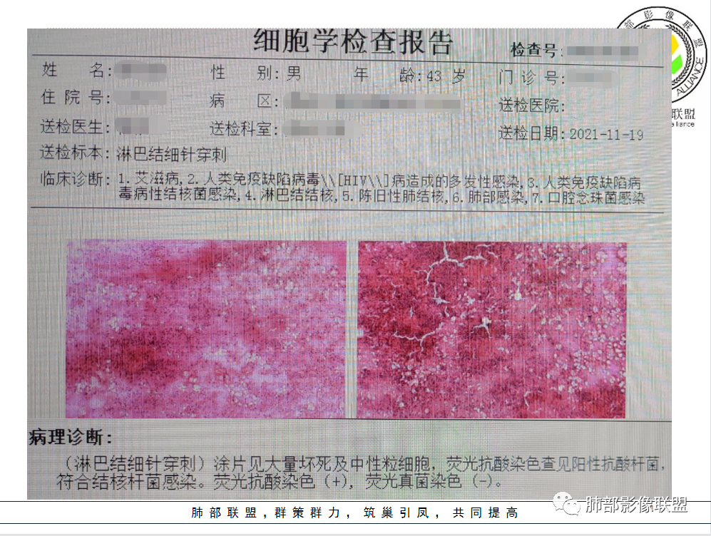 影像PPT - 【病例】HIV背景下的双肺多发性小结节-30 影像PPT - 【病例】HIV背景下的双肺多发性小结节-30