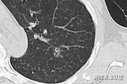 影像PPT - 【病例】HIV背景下的双肺多发性小结节-31 影像PPT - 【病例】HIV背景下的双肺多发性小结节-31