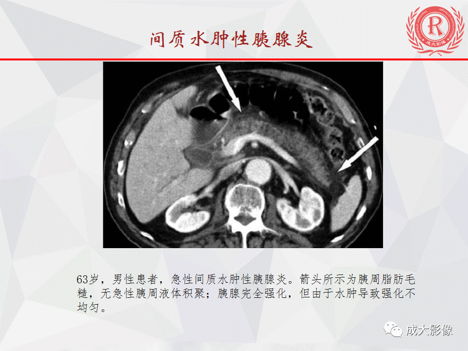 影像PPT - 【PPT】急慢性胰腺炎影像评价-8