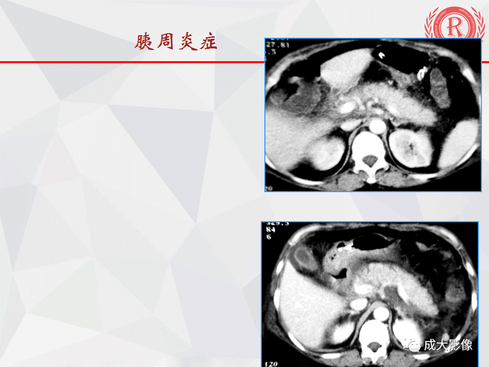 影像PPT - 【PPT】急慢性胰腺炎影像评价-12
