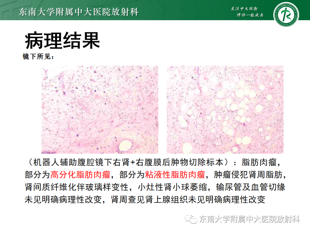 影像PPT - 【PPT】腹膜后脂肪肉瘤-3