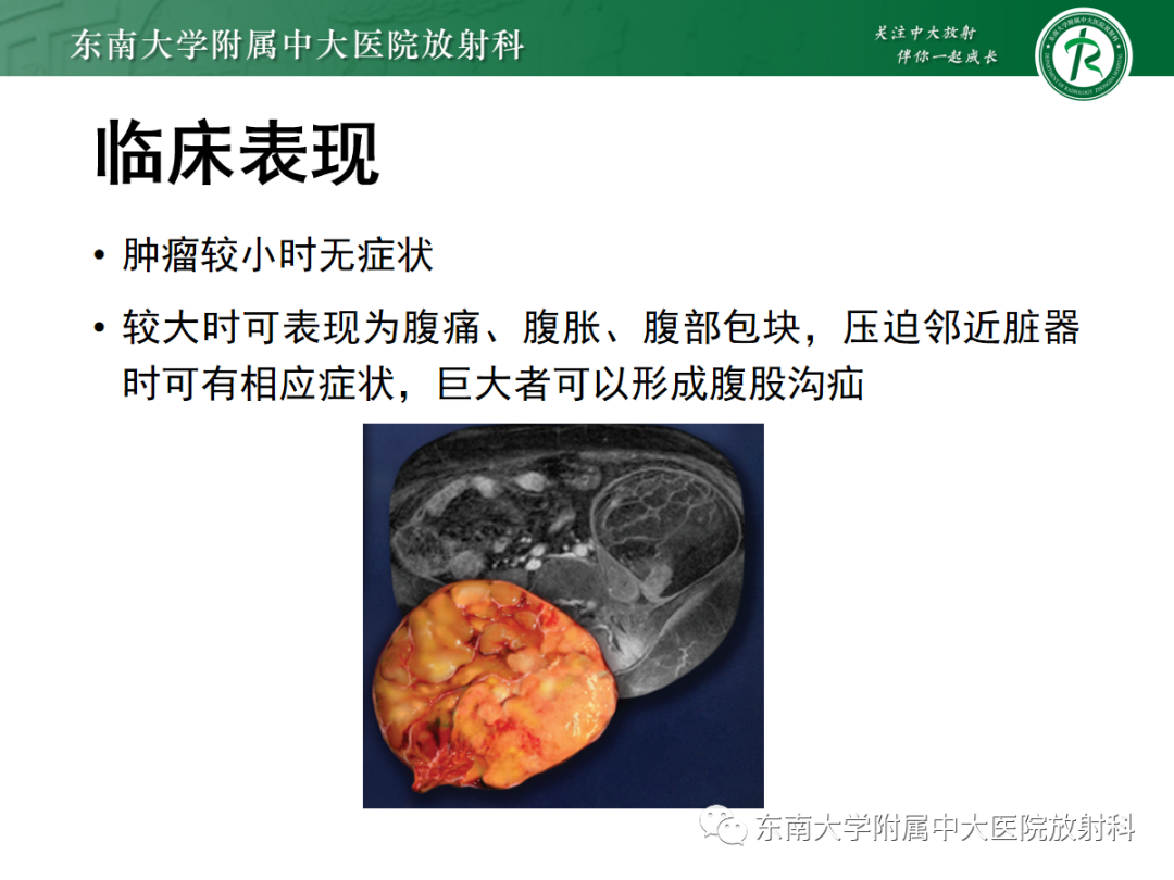 影像PPT - 【PPT】腹膜后脂肪肉瘤-6