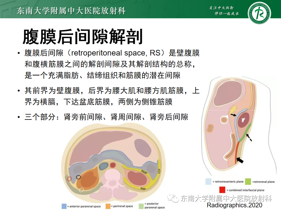 影像PPT - 【PPT】腹膜后脂肪肉瘤-7