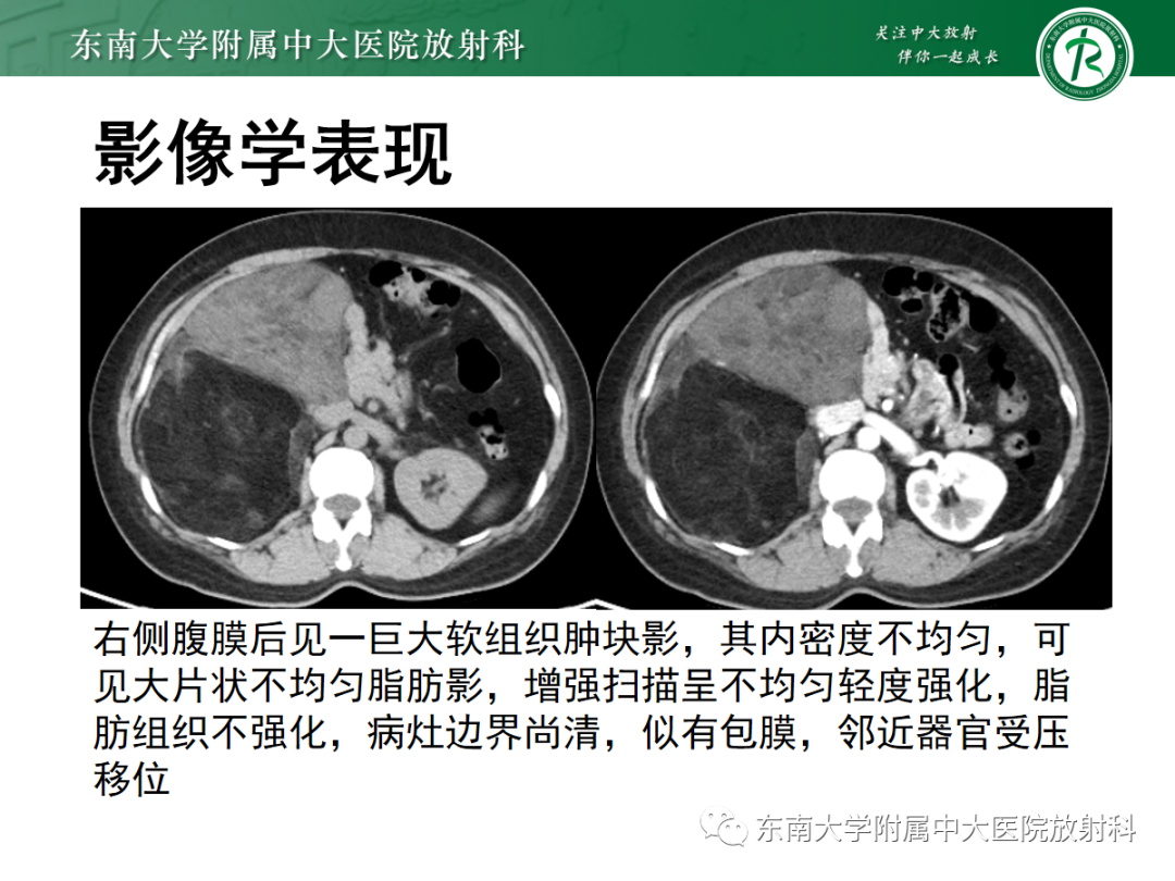 影像PPT - 【PPT】腹膜后脂肪肉瘤-2