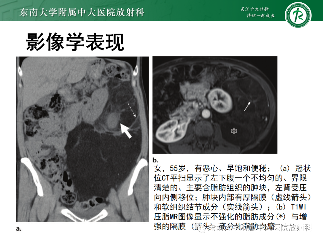 影像PPT - 【PPT】腹膜后脂肪肉瘤-12