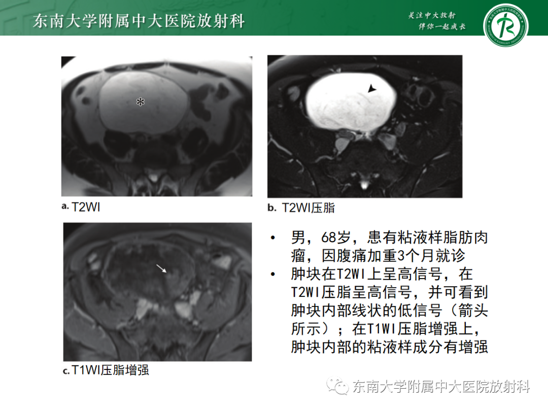 影像PPT - 【PPT】腹膜后脂肪肉瘤-14