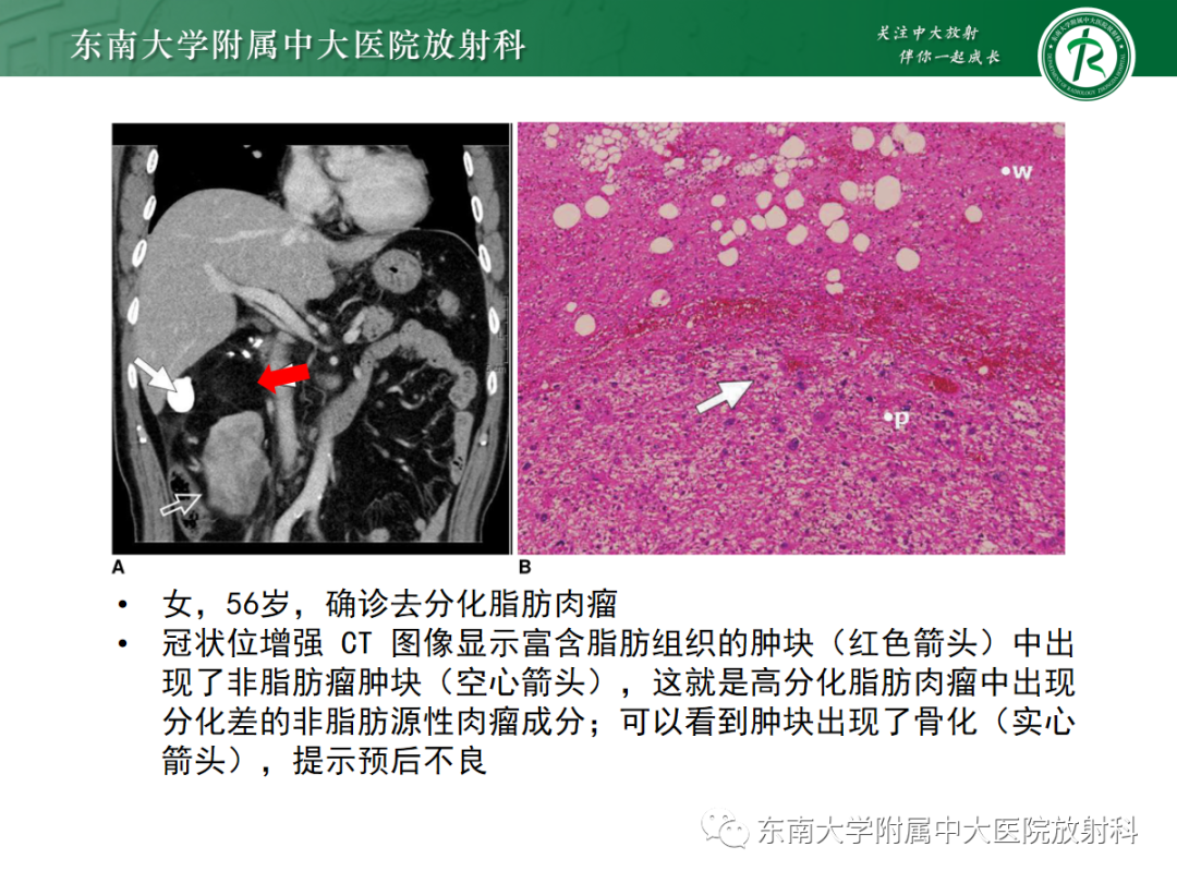 影像PPT - 【PPT】腹膜后脂肪肉瘤-16