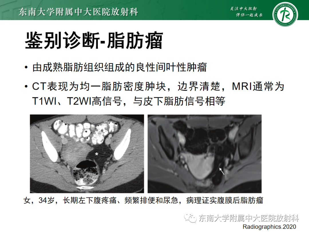 影像PPT - 【PPT】腹膜后脂肪肉瘤-20