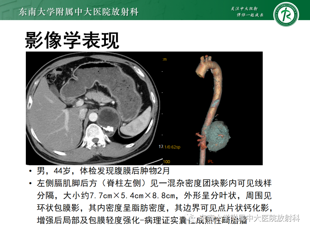 影像PPT - 【PPT】腹膜后脂肪肉瘤-22