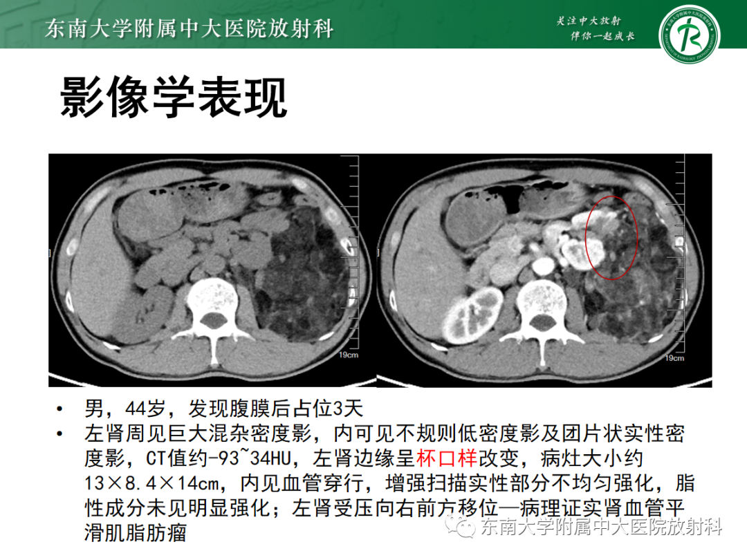 影像PPT - 【PPT】腹膜后脂肪肉瘤-24