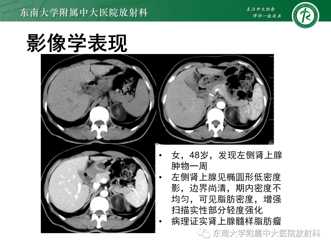影像PPT - 【PPT】腹膜后脂肪肉瘤-26